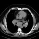 Sarcoidosis of lung, HRCT, hilar lymphadenopathy: CT - Computed tomography